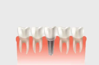 Dental Implants