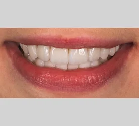 Smile Design