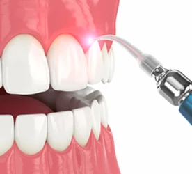 Laser Treatment