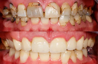 	Full Mouth Rehabilitation