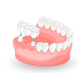 Dental
                                                    Caps and Bridges